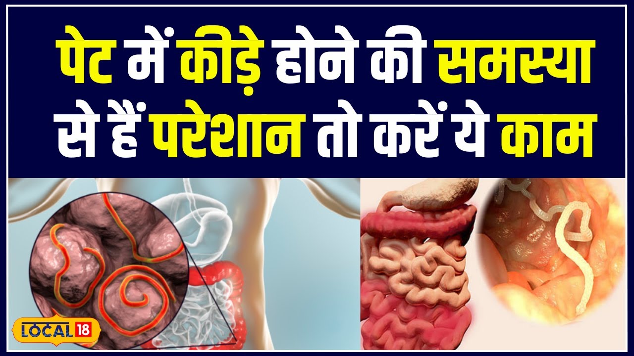 Health Tips:  पेट में कीड़े होने की समस्या से हैं परेशान, तो अपनाएं ये असरदार उपाय | #local18